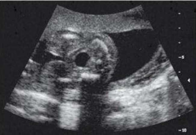 <p>By 15 weeks of menstrual age, over 90% of all normal fetal urinary bladders can be visualized; visualization is necessary to establish renal function; anechoic structure with thin hyperechoic wall in midline of pelvis; may increase and decrease in size during exam</p>