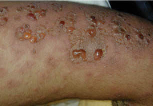 <p><span>•Antibodies directed at dermo-epidermal junction</span></p><p><span>•Intact epidermis forms roof of blister</span></p><p><span>•Blisters are usually tense and intact </span></p>