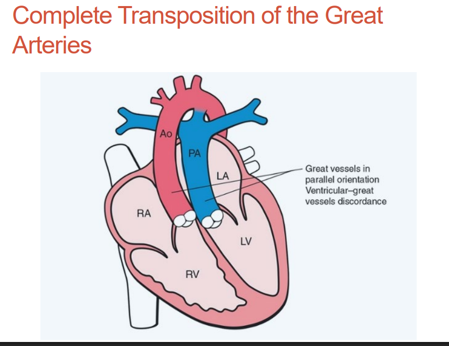 <p>Associated with maternal diabetes</p>