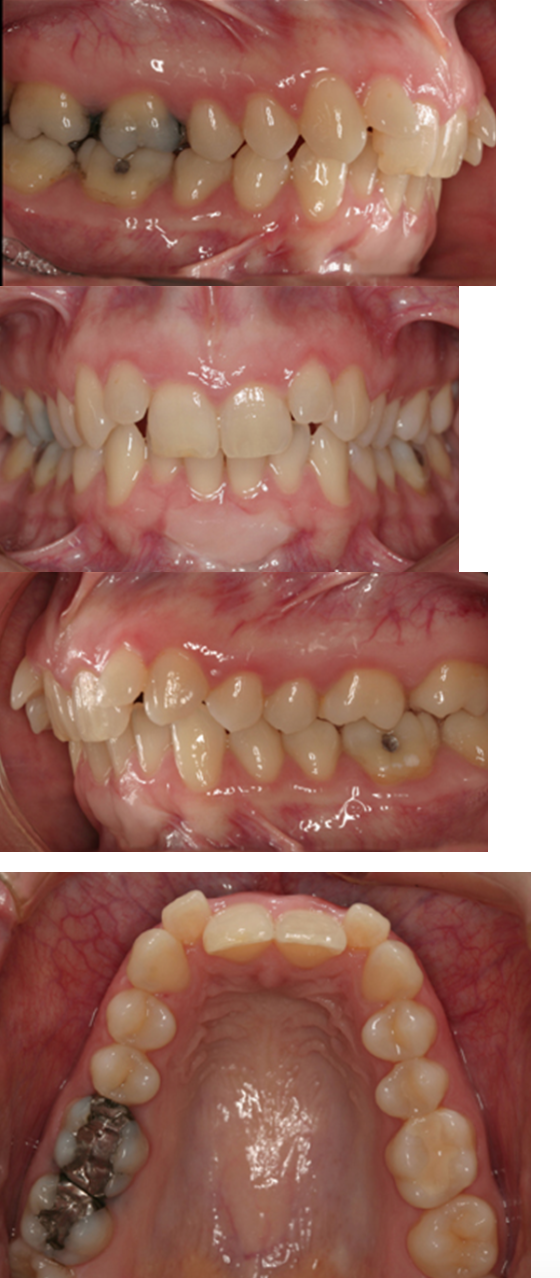 <p>What is the Angle's classification for this patient?</p>