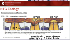 <p>A normal nerve will show a _____ in IOP to ICP</p>
