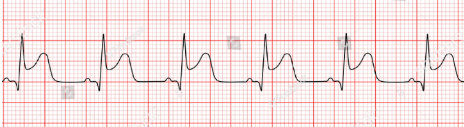 <p>what does this EKG show? (ST elevation or depression)</p>