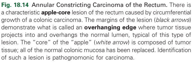 <p>colonic carcinoma</p>