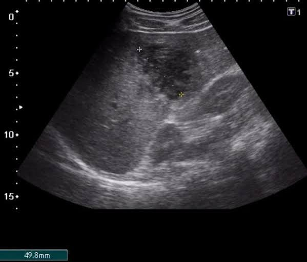 <ul><li><p>variable appearance, usually singular lesion </p></li><li><p>hypoechoic with TT</p></li><li><p>complex with debris and irregular walls </p></li><li><p>fluid level </p></li><li><p>dirty shadow (with gas forming bacteria) </p></li><li><p>hypervascularity around the lesion</p></li></ul><p></p>