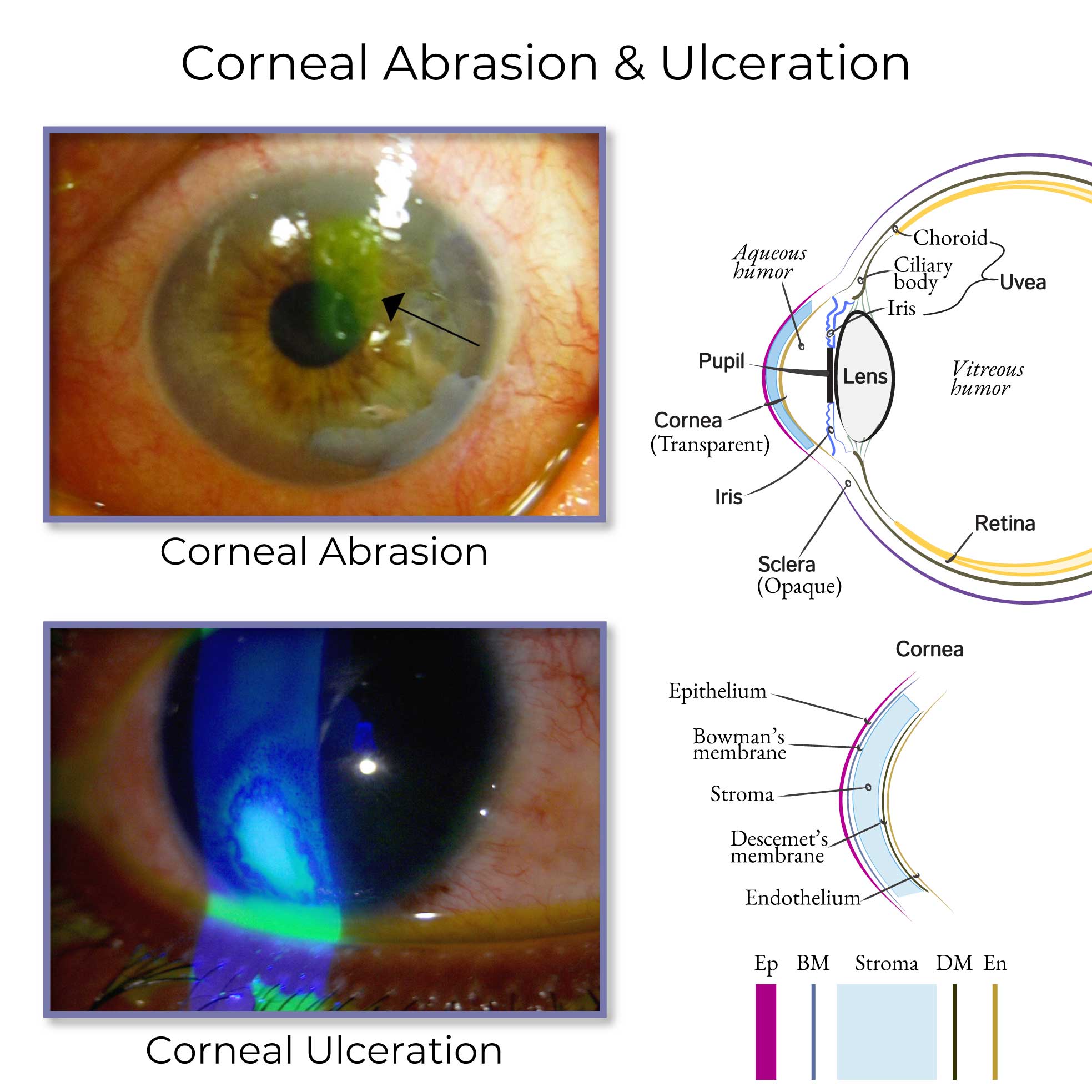 <p><u>corneal injury:</u><br>no break in epithelial layer/bowman’s membrane</p><p><u>corneal ulcer:</u><br>break in epithelial layer/bowman’s membrane→allows bacterial into stroma</p><p>I: trauma<br>contact lens use→hypoxia</p><p>DX:<br>focal white opacity+staining: epithelia defect+underlying hazy white infiltrate </p>