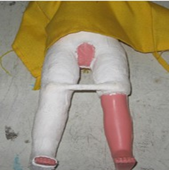 <p><span>hip and femur affections</span></p>