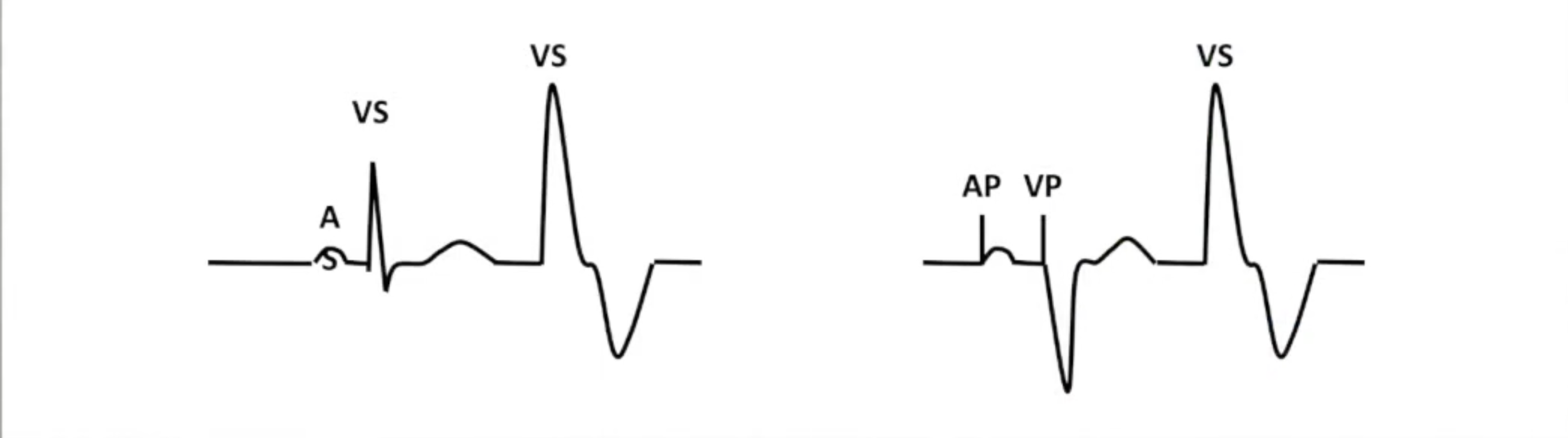 <ul><li><p>PVC defined by the device:</p><ul><li><p>Two consecutive ventricular events</p></li><li><p>No intervening atrial events</p></li><li><p>Second event is VS</p></li></ul></li></ul><p></p>
