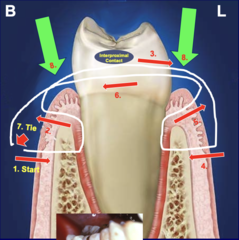 <p>Start facial 8 mm apical to papilla → pierce keratinized tissue → pierce facial underside 3 mm from coronal → go under contact to lingual → pierce lingual keratinized side 8 mm from coronal → pierce lingual underside 3 mm from coronal → back to facial under contact → tie.</p><p>(Explanation: This technique pulls flaps apically, anchoring them to bone for procedures like crown lengthening, with deeper (8 mm) and coronal (3 mm) piercings to secure tissue under tension.)</p>