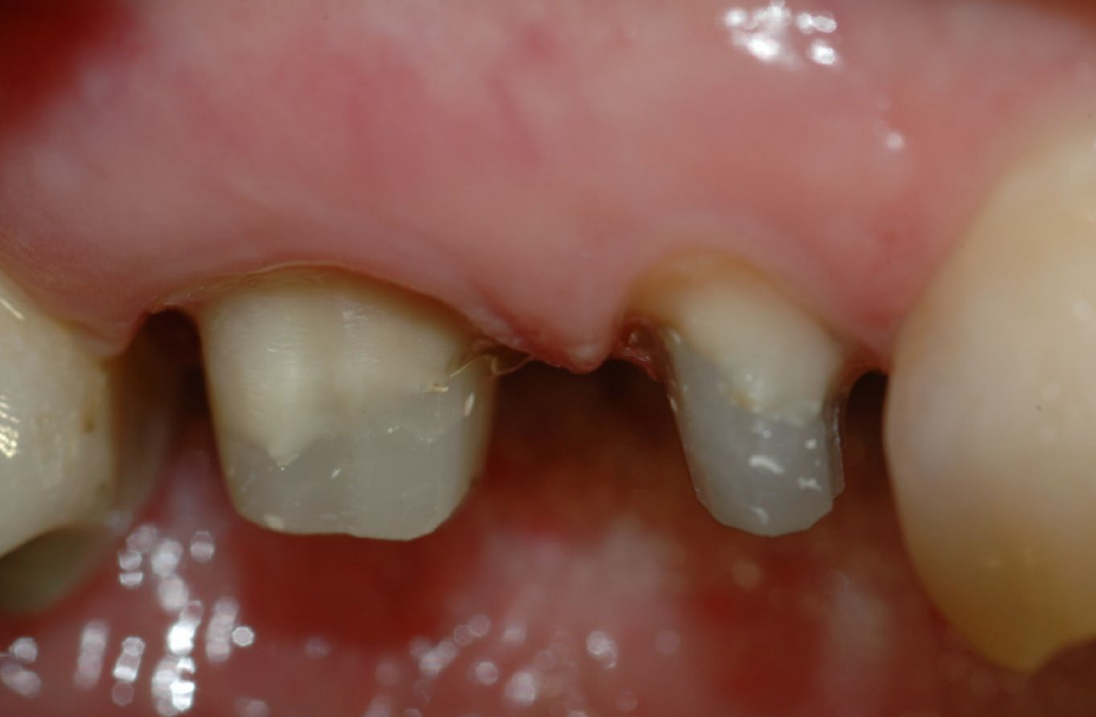 <p>what is dentin vs composite? </p>