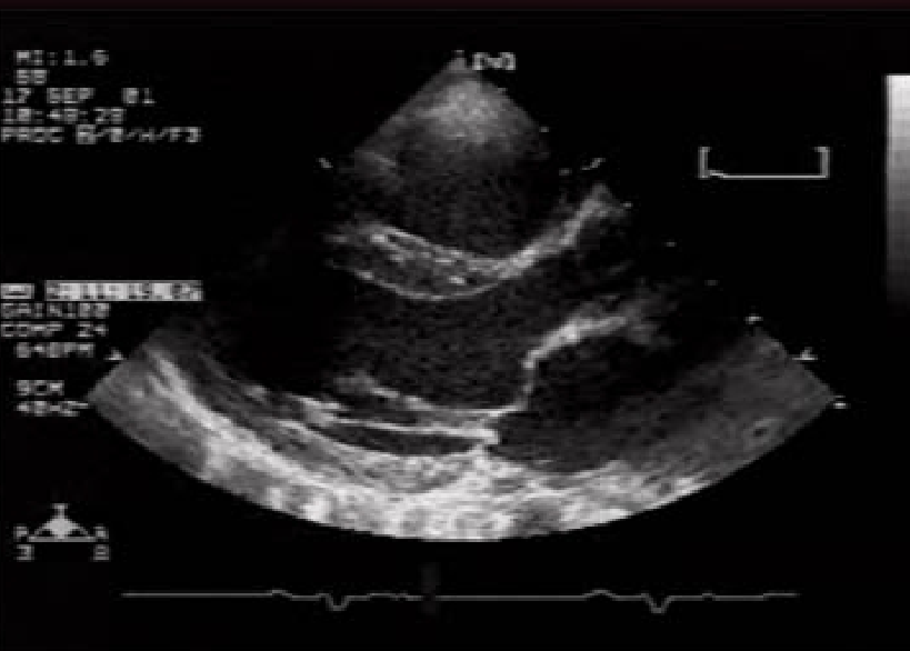 <p>diastole</p>