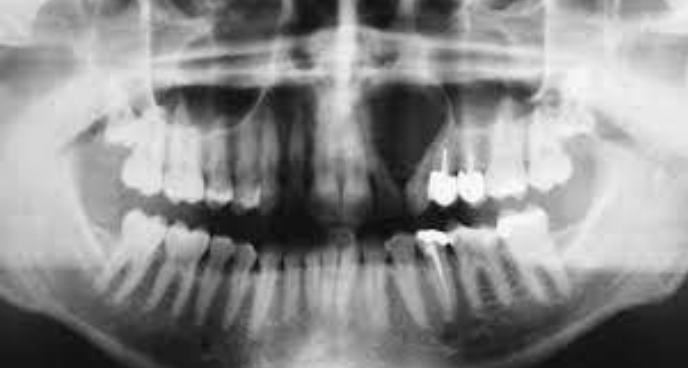 <p>A 31 year old presenting with a cystic swelling in lateral aspect between lateral incisors and canine. Provide differential diagnosis</p>