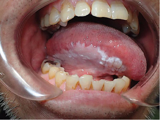 <p>CASE: A 58-year-old patient has a persistent white plaque on the lateral tongue. It does not wipe off, and no specific traumatic, infectious, or other white-plaque diagnosis explains it. What is the best clinical term for this lesion, and what does that term imply?</p>