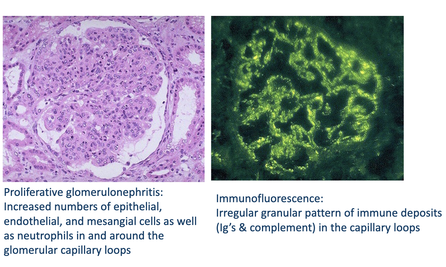 <ul><li><p>IgA nefropathie</p><ul><li><p>vaakst</p></li><li><p>terugkerende episodes van hematuria die 1-3d komen na BLWI</p></li><li><p>urine teurg naar normaal binnen paar dagen, micro kan langer aanhouden</p></li></ul></li><li><p>post-streptokokken glomnef </p><ul><li><p>treedt typisch op 2 weken na BLWI of 3w na huidinfectie</p></li><li><p>vaak B-hemolytic streptococci group A</p></li><li><p>kinderen onder 7j → want ze krijgen geen AB </p></li></ul></li><li><p>non spec mesangiale prolif glomnef </p><ul><li><p>binnen paar maanden over </p></li></ul></li></ul><p></p>