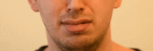 <p>Nasolabial Deepener</p>