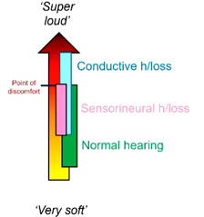 <p>what is the dynamic range of people with SNHL?</p>