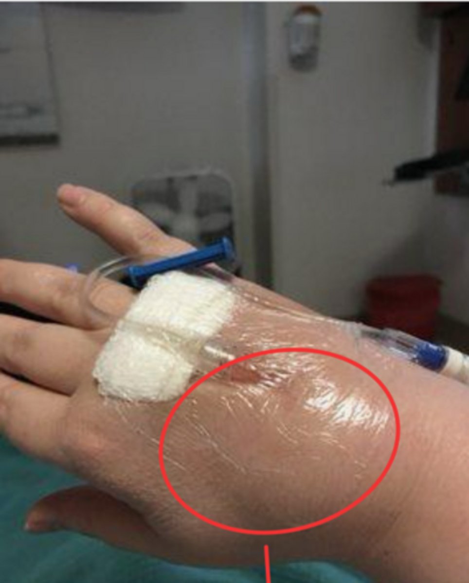 <p>escape of fluid or blood from a vessel into surrounding tissue (blown vein)</p>