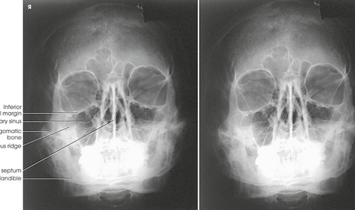 <p>structures shown for MOD WATERS FACIAL BONES</p>