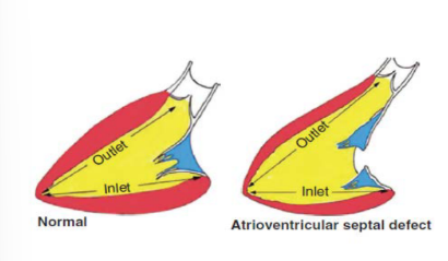 <p>In a normal heart, the inlet and outlet distances are equal. In an AVSD, the distance from the apex to the outflow tract is longer because the LVOT is elongated.</p>