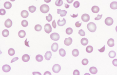 <p>What does this blood smear diagnose?</p>