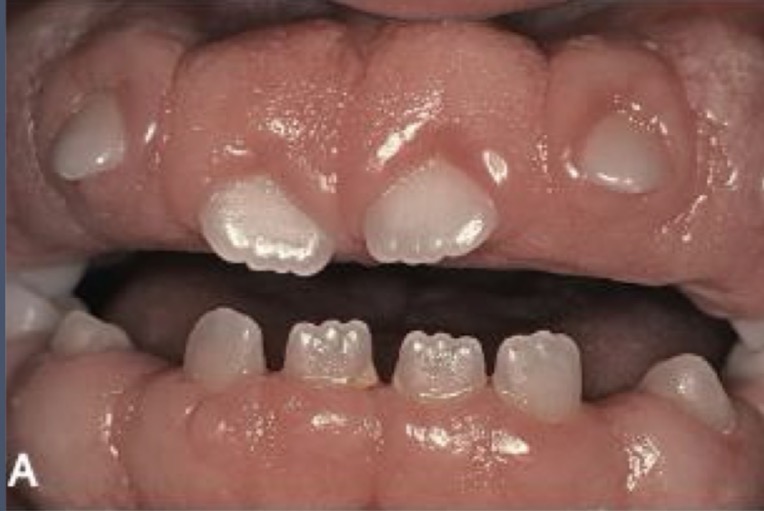 <p>Rare lobed alteration in inserted gum---in papilla and MGV</p><p>Pale pink color, firm and completely covers the crown</p><p>Unknown cause</p><p>Painless</p><p>In primary or secondary dentition</p><p>Surgical treatment</p>