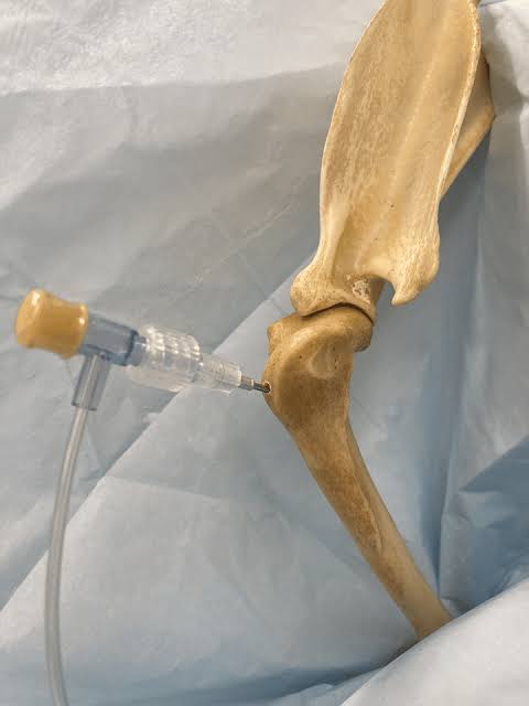 <p>Intraosseous (IO) catheter sites</p>