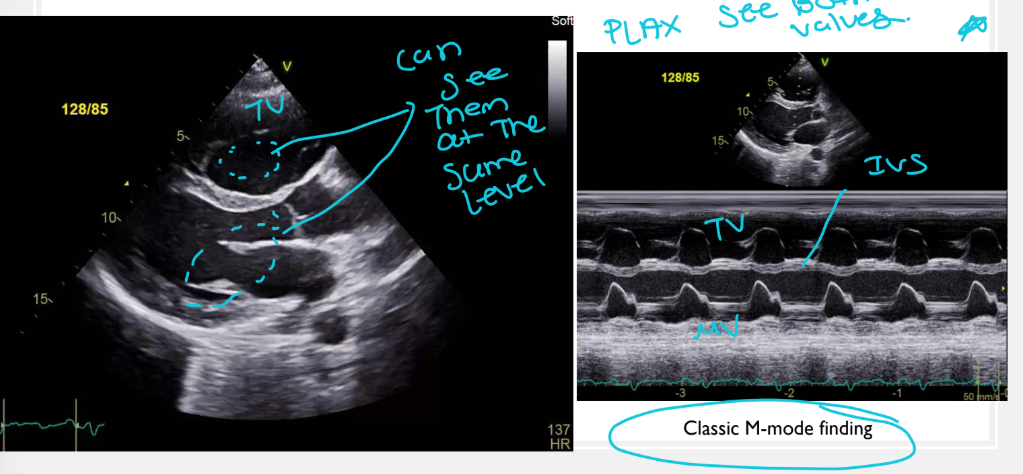 <p>The displaced tricuspid valve may appear at the <strong>same level as the mitral valve</strong> in PLAX and PSAX views.</p>