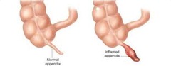 <p>Inflammation of appendix, can lead to peritonitis.</p>