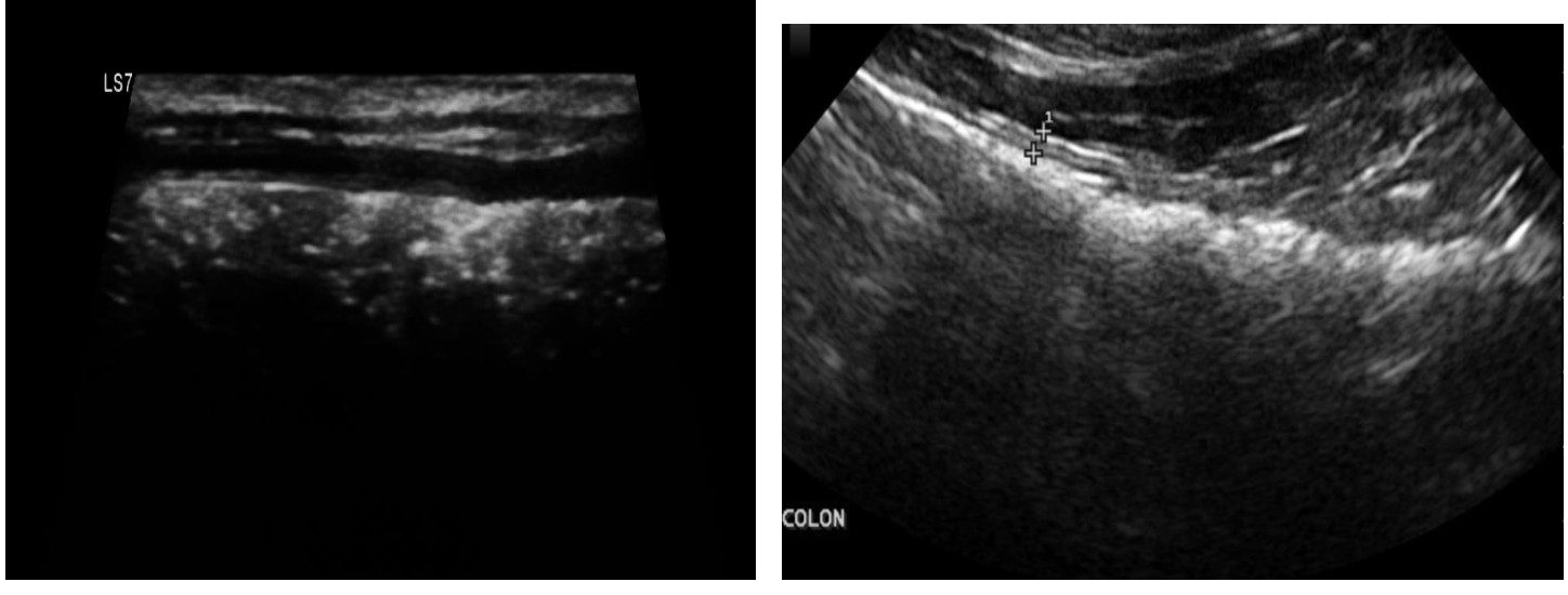 <p>what does the following ultrasound show?</p>