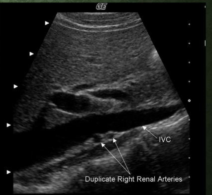 <p>What approach is used to identify renal artery origins?<br>→ Transverse HH approach</p><p>HH most likely stands for “heel-toe” approach/maneuver.</p><p>What velocities are measured in renal duplex?<br>→ PS and ED velocities</p><p>Name the 3 renal artery segments evaluated with velocities.<br>→ Proximal, mid, distal</p><p>What index is determined during renal duplex?<br>→ Resistive index</p><p>What additional arteries should always be noted?<br>→ Secondary/accessory renal arteries</p>
