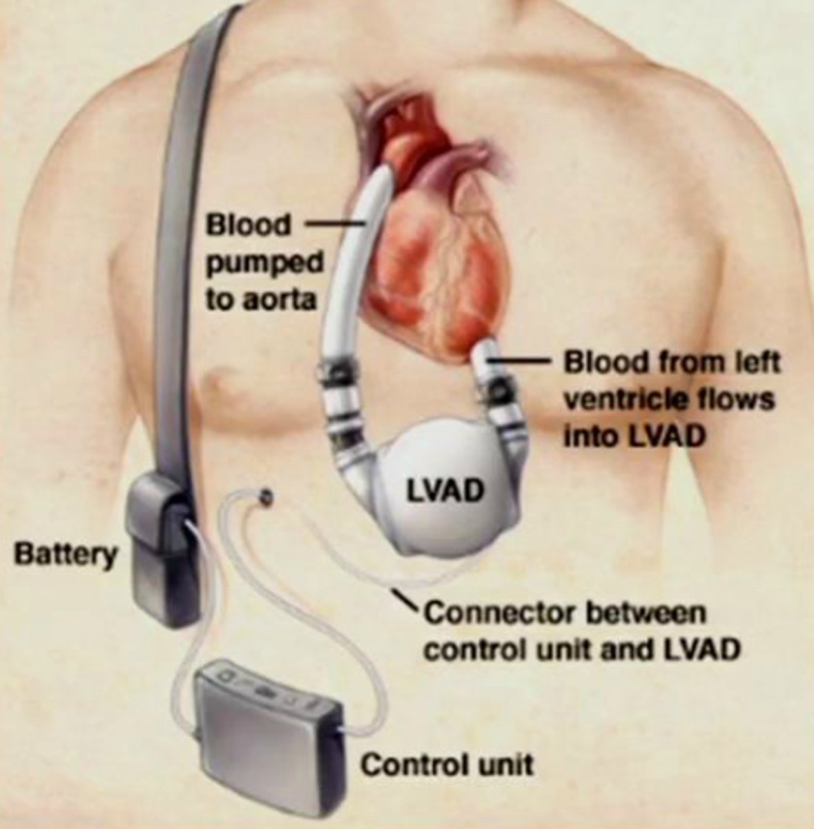 <p>T or F: A ventricular assist device requires a power source to function properly. The drive line connects to the power source. If the OTR is not careful, the drive line can become disconnected during activity.</p>
