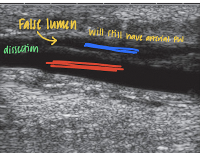 <ul><li><p>dissections</p></li><li><p>intimal flaps</p></li><li><p>aneurysms</p></li><li><p>pseudoaneurysms</p></li><li><p>hematomas</p></li></ul><p></p>