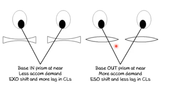 <p>accom and convergence does not change with contact lenses as no BVP </p>
