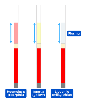<p>urine specific gravity - PCV vs TP</p>