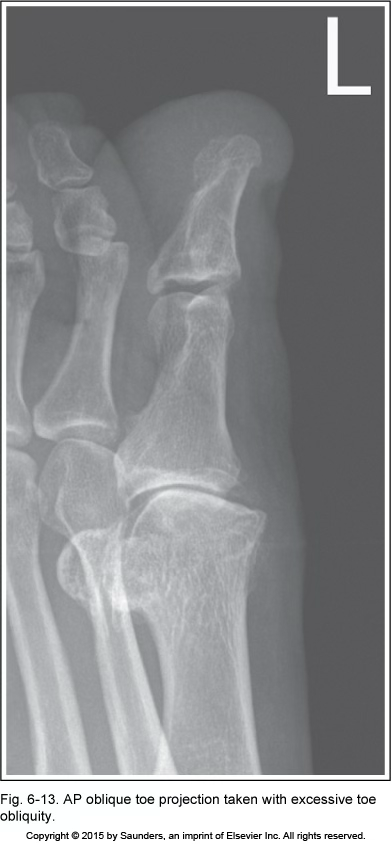 <p>AP oblique toe</p>