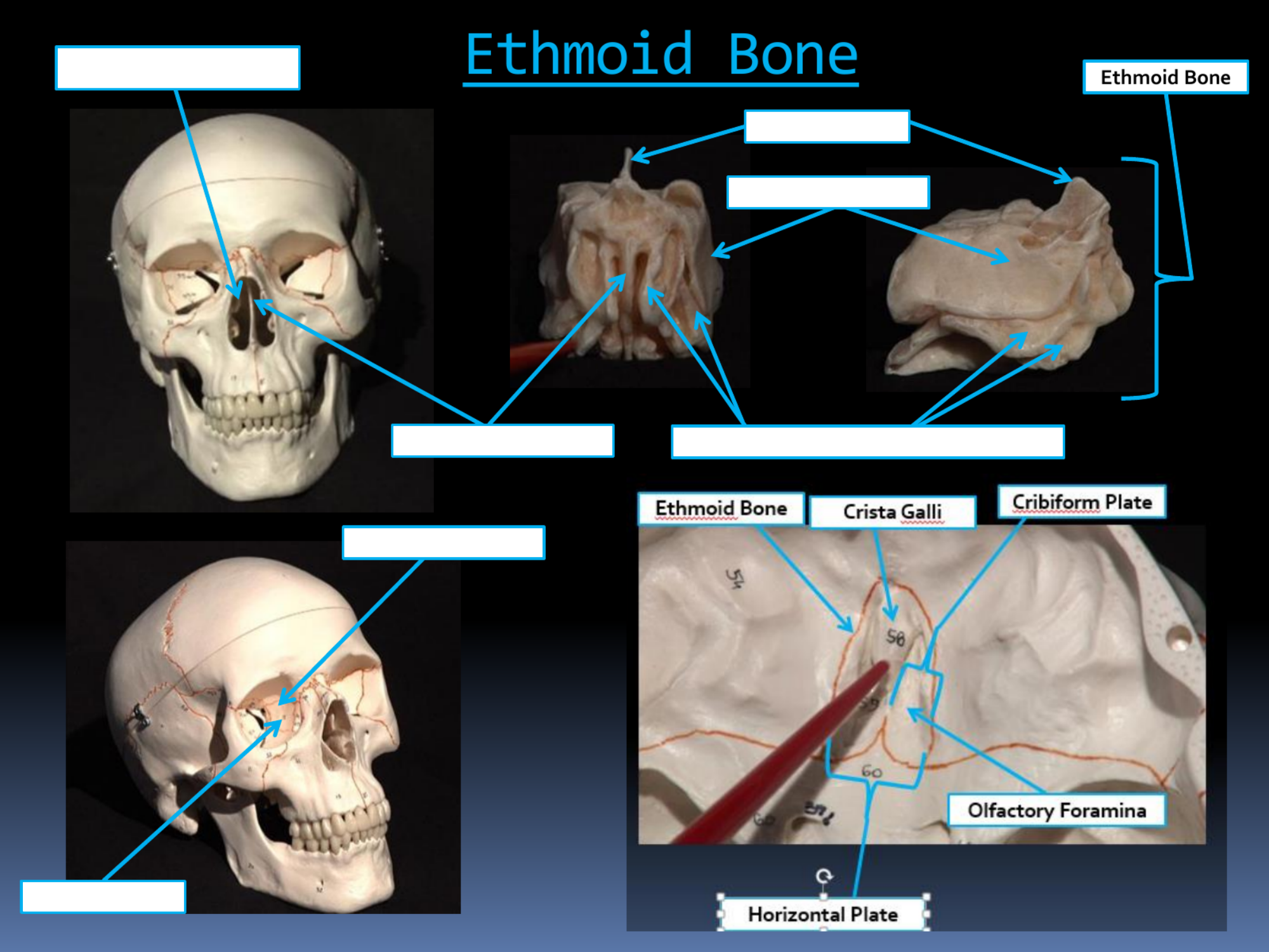 <p>EthmoidBone</p>