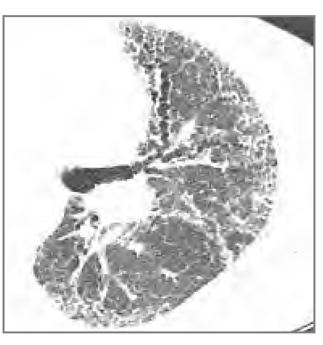 <p>What 2 features are shown here? What condition is this?</p>