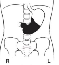 <p>What position is the patient in? Air = black. Barium = white</p>
