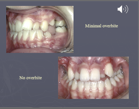 <ul><li><p><strong>Reduced overbite </strong>(increased vertical dimension), so correction of cross bite of the lateral incisors but relapse of crossbite because of the increased vertical dimension (combination of fixed and removable can be used)</p></li><li><p><strong>No overbite</strong></p></li></ul><p></p>