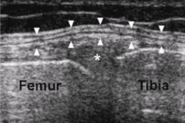 <ul><li><p><span style="background-color: transparent;">Hyperechoic linear bands</span></p><ul><li><p><span style="background-color: transparent;">Less prominent bands than tendons</span></p></li></ul></li><li><p><span style="background-color: transparent;">No muscle component</span></p></li></ul><p></p>