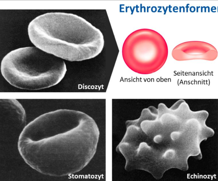 <p><span>Erythrozyten</span><br></p><ul><li><p><strong>Discozytische Form</strong> =Membranflächenüberschuss</p><ul><li><p>Grund</p><ul><li><p>Verbesserte Verformbarkeit und damit bessere Passage durch Kapillaren&nbsp;</p></li><li><p>Durchmesser der Kapillaren bis hinab zu ca. 4μm ist kleiner als der Durchmesser eines Erythrozyten mit ca. 8μm</p></li><li><p>Verbesserter Austausch der Atemgase</p></li></ul></li><li><p>Discozytische Formen sind die Ruheform der&nbsp;Erythrozyten</p></li><li><p>Diese kommt im Kreislauf normalerweise nicht vor, da die Erythrozyten dort so gut wie nie in Ruhe sind!</p></li></ul></li><li><p><strong>Stechapfelform</strong> (bei leichter osmotischer Schrumpfung oder in saurem Milieu)</p></li><li><p><strong>Stomatozytische Form </strong>= Tassenform) (bei leichter osmotischer Schwellung oder in basischem Milieu)</p></li></ul><p><span>Die beiden letzten Formen kommen normalerweise nicht vor und sind nur durch massive Änderung der externen Bedingungen zu provozieren.</span></p>