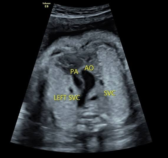 <ul><li><p>VSD</p></li><li><p>overriding aorta</p></li><li><p>pulmonic stenosis </p></li><li><p>enlarged right ventricle </p></li></ul><p></p>
