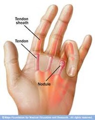 <p>common in DM, stenosing tenosynovitis, nodule at MCP of ring or index finger</p>
