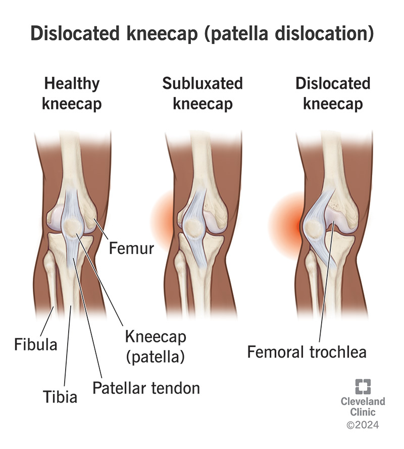 <p>Joint Dislocation</p><ul><li><p>bones of a joint are forced <strong>completely </strong>out of their normal alignment or position</p></li><li><p>(loss of normal joint contact)</p></li></ul><p></p>