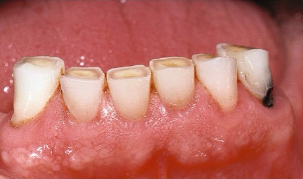 <p>What is Attrition?</p>