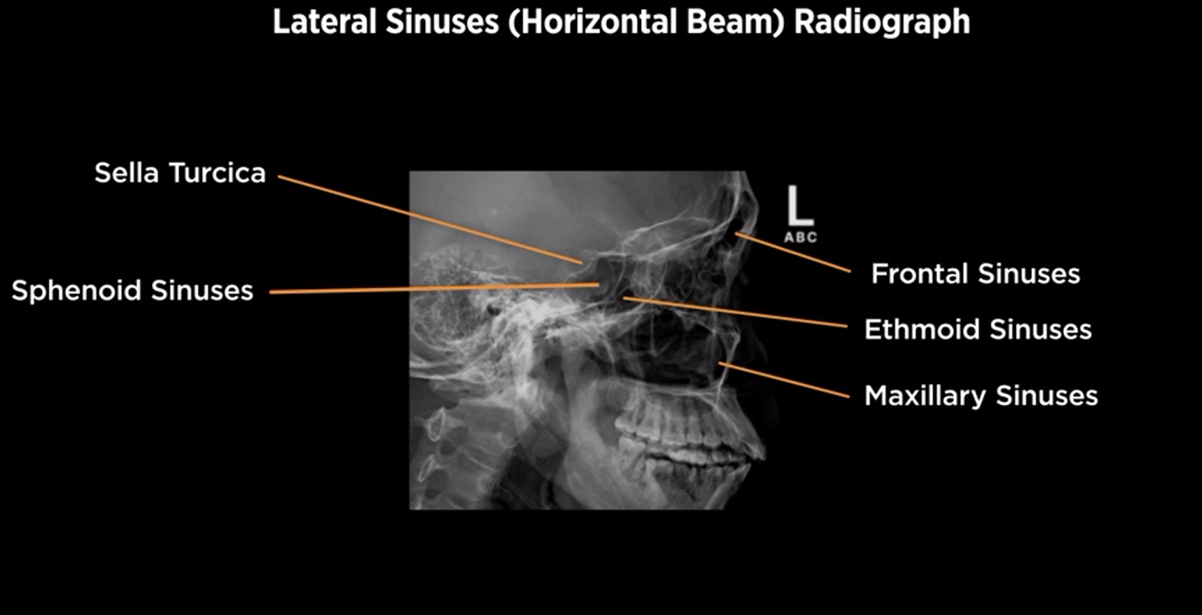<p>Lateral sinus</p>