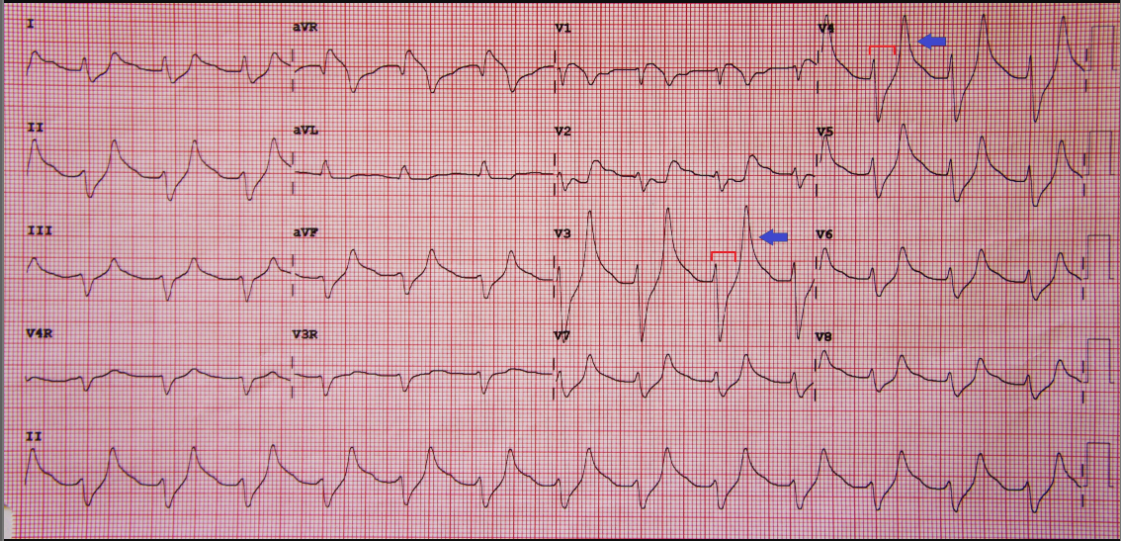 <p>howd yk this was Hyperkalemia</p>