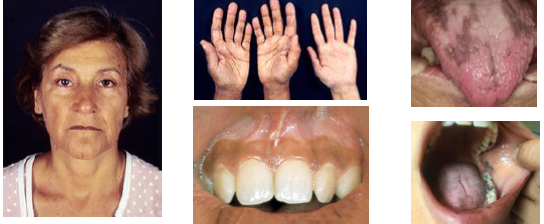 <p>• Fatigue weakness weight loss and nausea present</p><p>•Hypoglycemia due to cortisol deficiency state</p><p>•Diffuse skin hyperpigmentation bronze appearance</p><p>•Oral mucosa shows brown macules or patches</p><p>•Pigmentation may increase over time gradually</p>