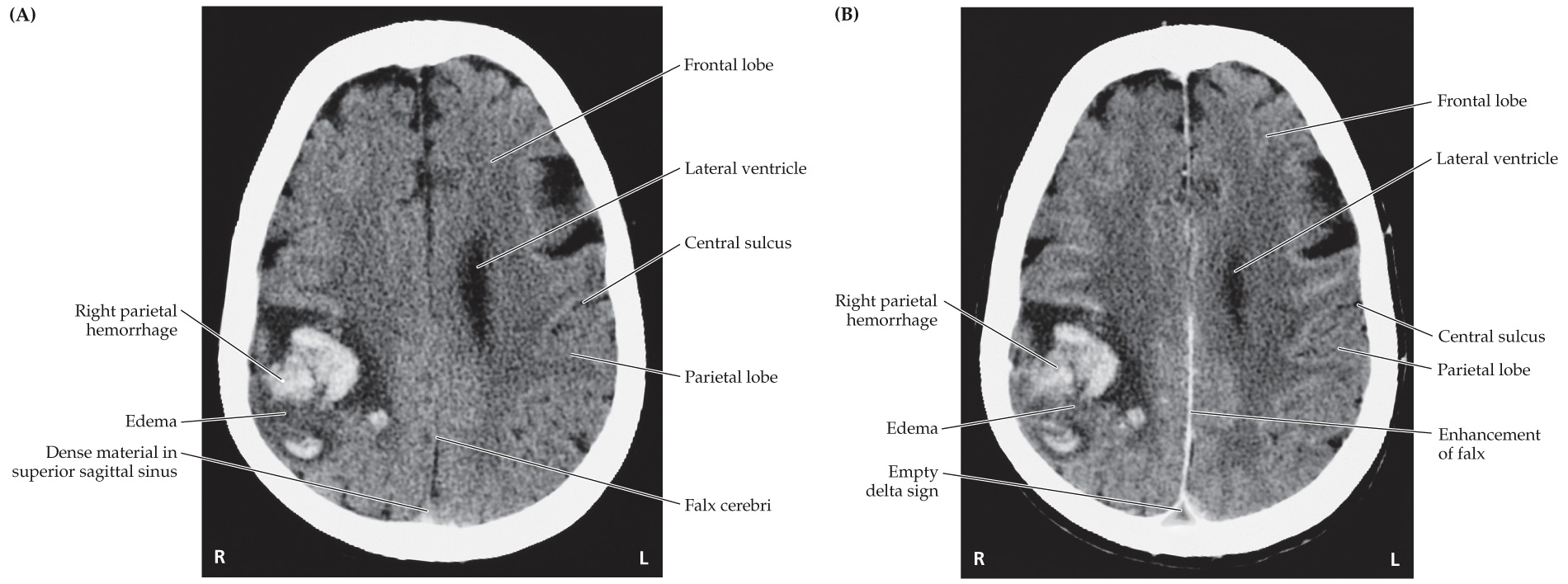<p>Right face and arm motor cortex, right MCA</p>