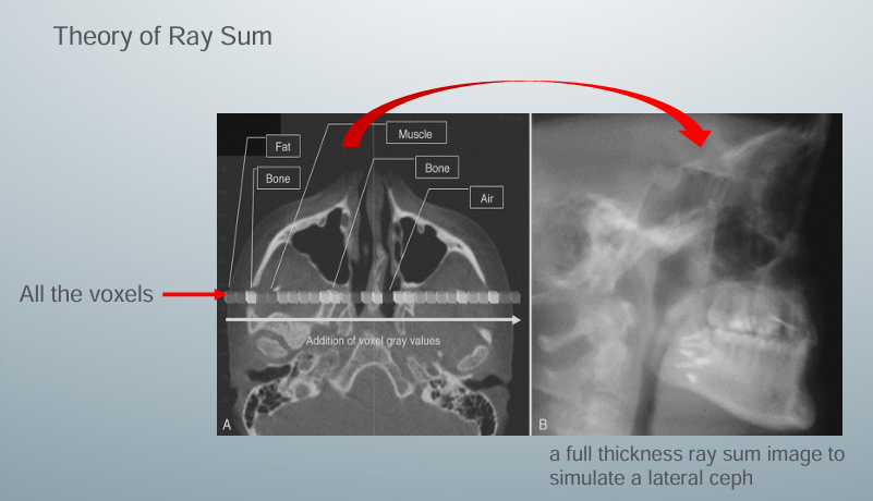 <p>-not an actual 3D reconstruction</p><p>-get this image by finding a slice you like and pressing the ray sum function in the CBCT software</p><p>-software takes all the voxels within a selected thickness of the slice you like and adds them together (sums them) to give a thick slab of the image</p><p>-all the voxels represent air, bone, and soft tissues</p>