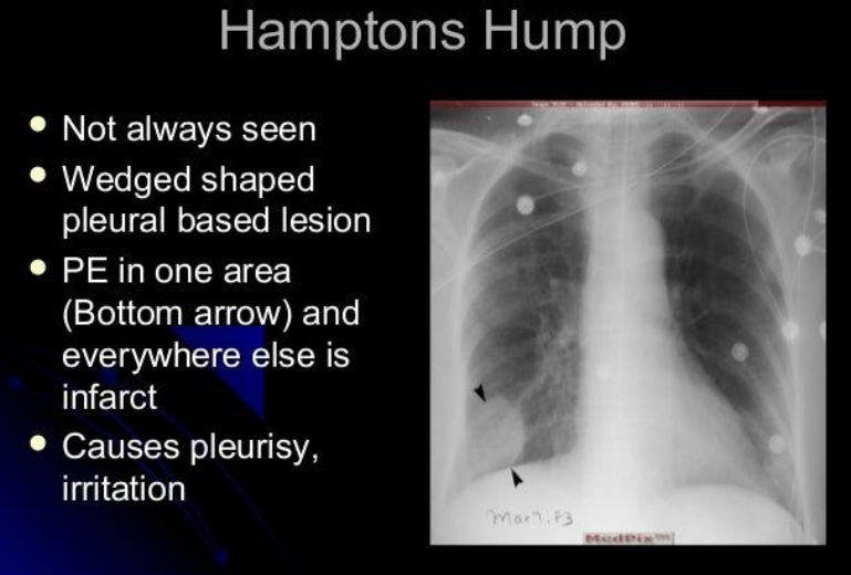 <p>Hampton’s Hump: Wedge-shaped opacity indicating lung tissue death (infarct).</p><ul><li><p>won’t always see bc dual blood supply that’s why need CT angiogram</p></li></ul><p></p>